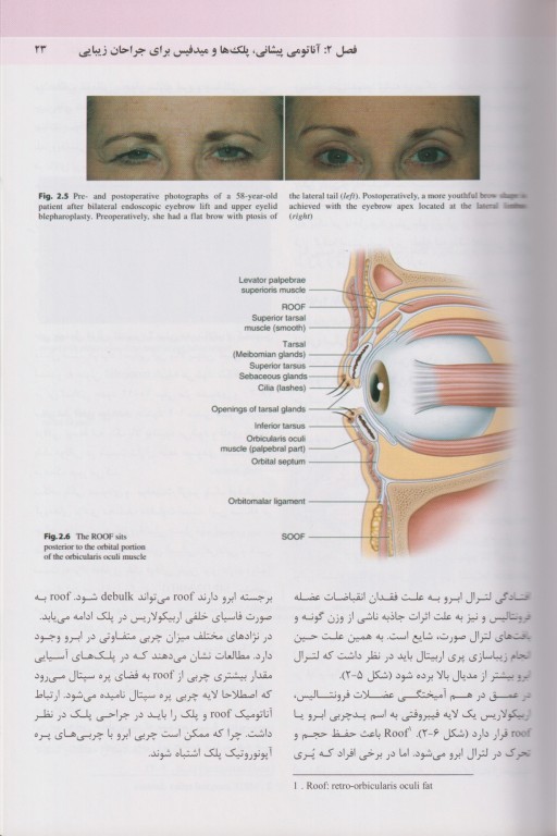 تکنیک‌های اصلی بلفاروپلاستی و جوان‌سازی پری‌اربیتال