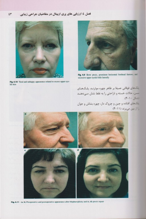 تکنیک‌های اصلی بلفاروپلاستی و جوان‌سازی پری‌اربیتال