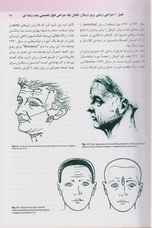 تکنیک‌های اصلی بلفاروپلاستی و جوان‌سازی پری‌اربیتال