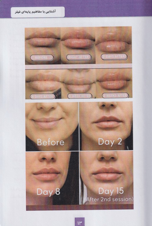 مفاهیم کاربردی فیلر صورت