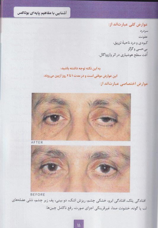 مفاهیم کاربردی بوتاکس