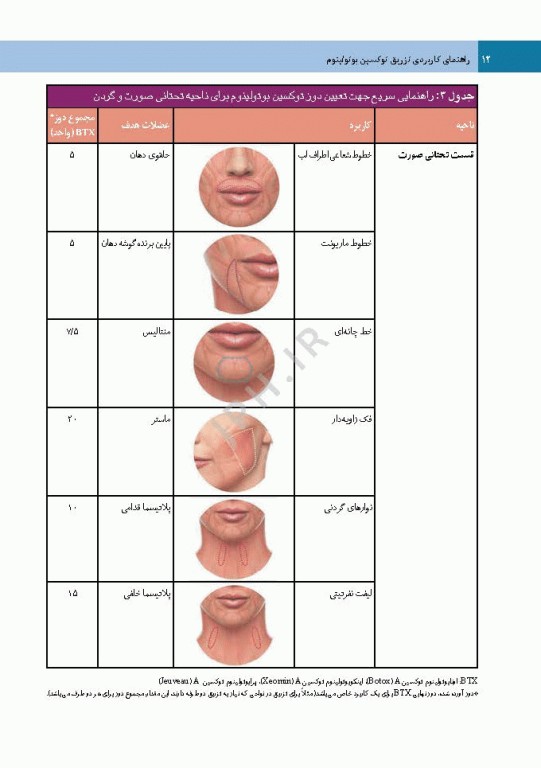 راهنمای کاربردی تزریق توکسین بوتولینوم دکتر رمزی
