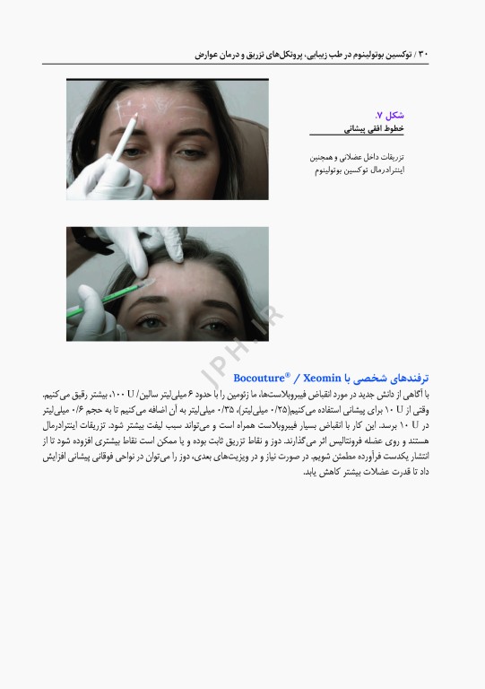 توکسین بوتولینوم در طب زیبایی، پروتکل های تزریق و درمان عوارض