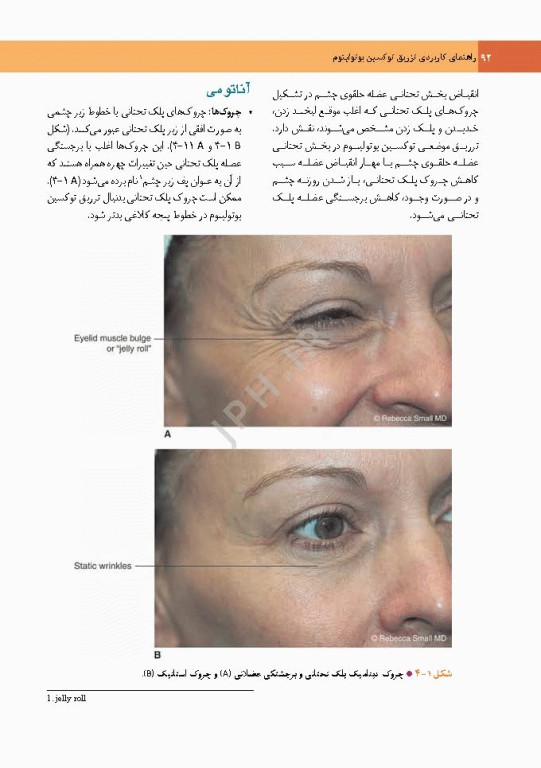 راهنمای کاربردی تزریق توکسین بوتولینوم دکتر رمزی