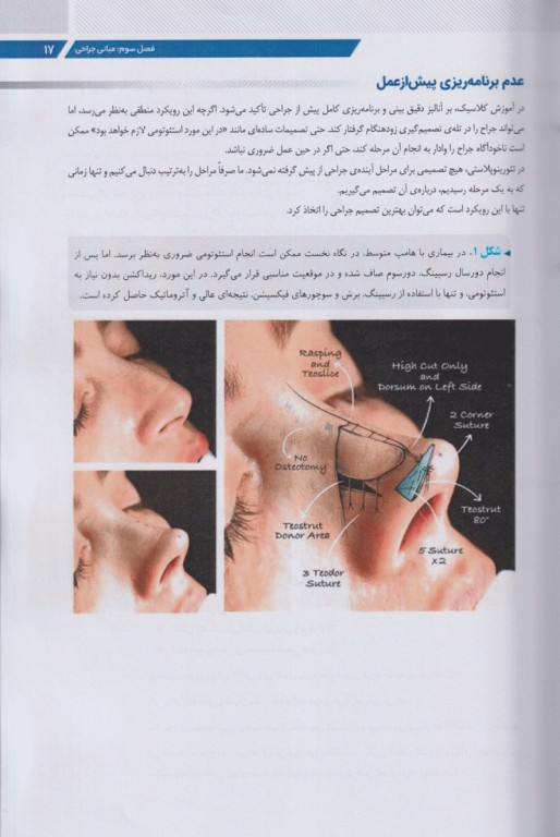 تئورینوپلاستی