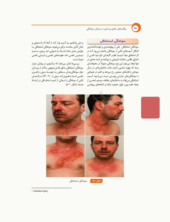 مراقبت‌های جامع پرستاری در بیماران سوختگی از اورژانس تا بازتوانی